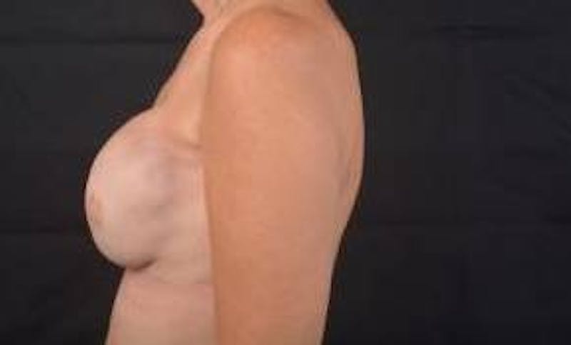 Immediate Breast Reconstruction – Nipple Sparing Before & After Gallery - Patient 205430 - Image 4