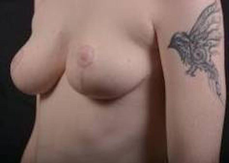 Mastopexy Before & After Gallery - Patient 656836 - Image 8