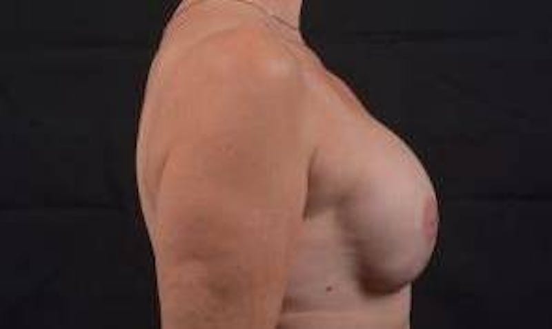 Reconstructive Breast Revision Before & After Gallery - Patient 348145 - Image 6