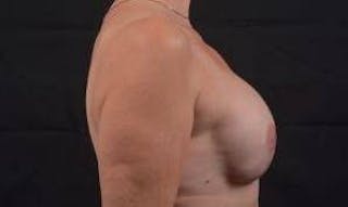 Reconstructive Breast Revision Before & After Gallery - Patient 348145 - Image 6