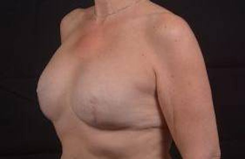Reconstructive Breast Revision Before & After Gallery - Patient 348145 - Image 7