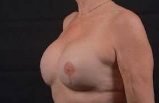 Reconstructive Breast Revision Before & After Gallery - Patient 348145 - Image 8