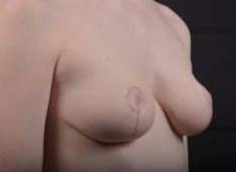 Mastopexy Before & After Gallery - Patient 656836 - Image 10