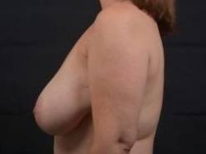 Oncoplastic Reconstruction Before & After Gallery - Patient 475411 - Image 3