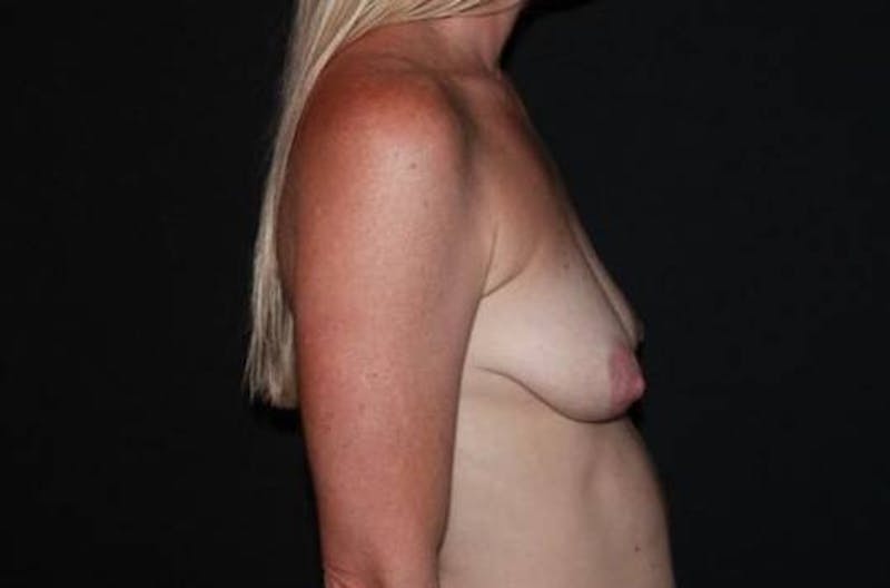 Breast Augmentation Mastopexy Before & After Gallery - Patient 432382 - Image 9