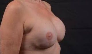 Reconstructive Breast Revision Before & After Gallery - Patient 348145 - Image 10