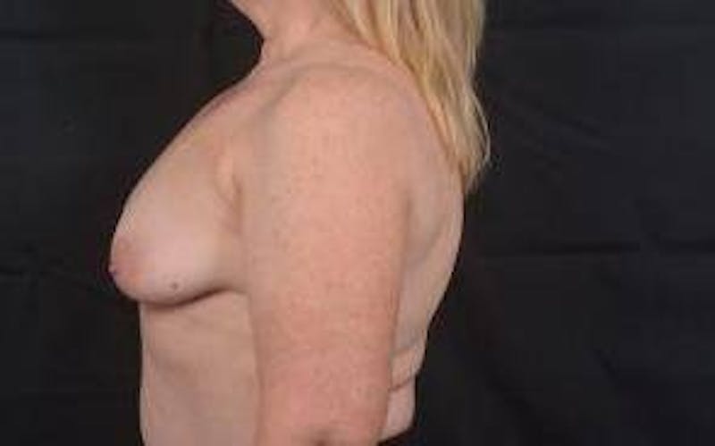 Mastopexy Before & After Gallery - Patient 702514 - Image 3