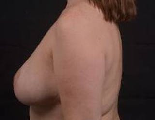 Oncoplastic Reconstruction Before & After Gallery - Patient 475411 - Image 4