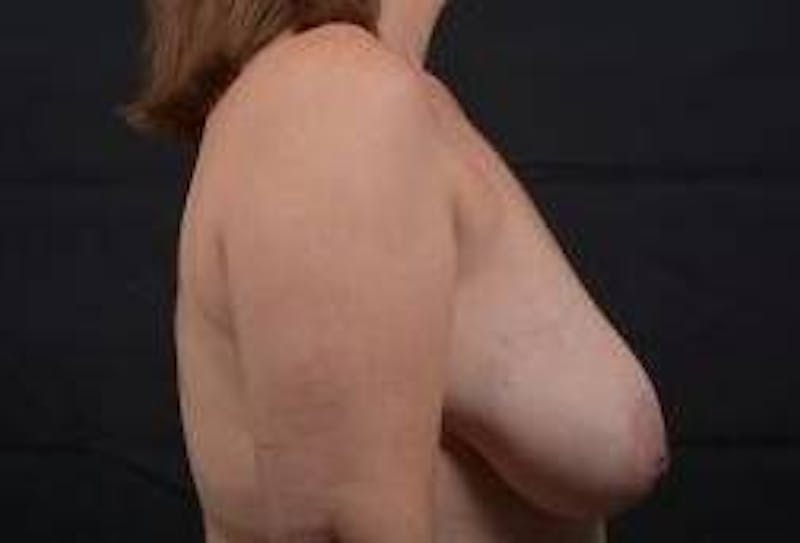 Oncoplastic Reconstruction Before & After Gallery - Patient 475411 - Image 5