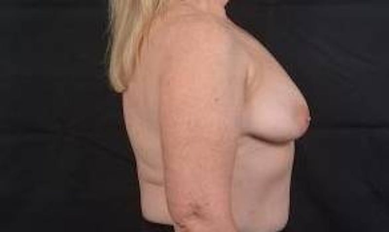 Mastopexy Before & After Gallery - Patient 702514 - Image 5