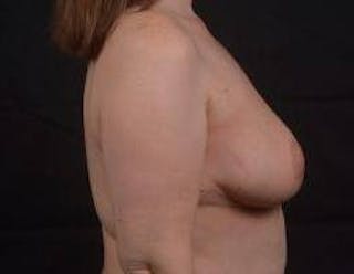 Oncoplastic Reconstruction Before & After Gallery - Patient 475411 - Image 6