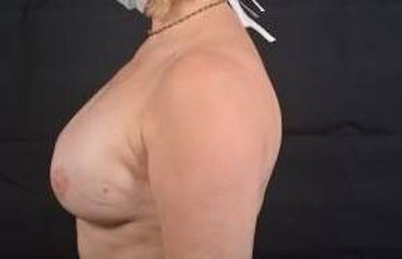 Immediate Breast Reconstruction – Nipple Sparing Before & After Gallery - Patient 119864 - Image 4
