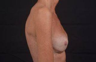 Reconstructive Breast Revision Before & After Gallery - Patient 155176 - Image 6