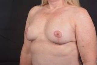 Mastopexy Before & After Gallery - Patient 702514 - Image 8