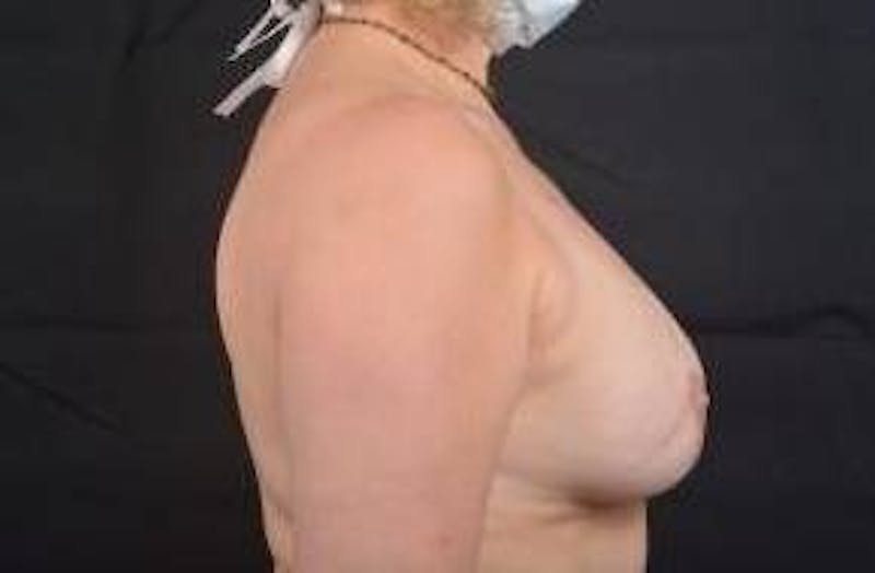 Immediate Breast Reconstruction – Nipple Sparing Before & After Gallery - Patient 119864 - Image 6