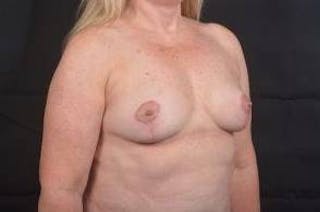 Mastopexy Before & After Gallery - Patient 702514 - Image 10