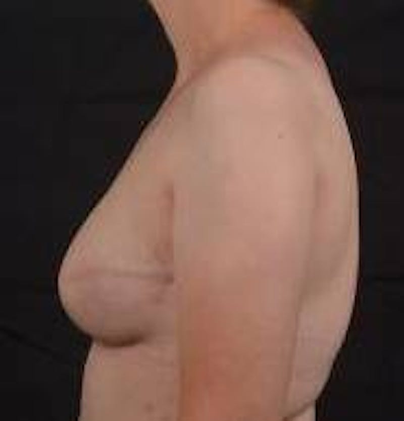 Immediate Breast Reconstruction – Skin Sparing Before & After Gallery - Patient 273114 - Image 4