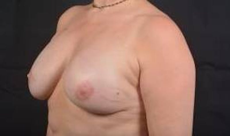 Immediate Breast Reconstruction – Nipple Sparing Before & After Gallery - Patient 119864 - Image 8