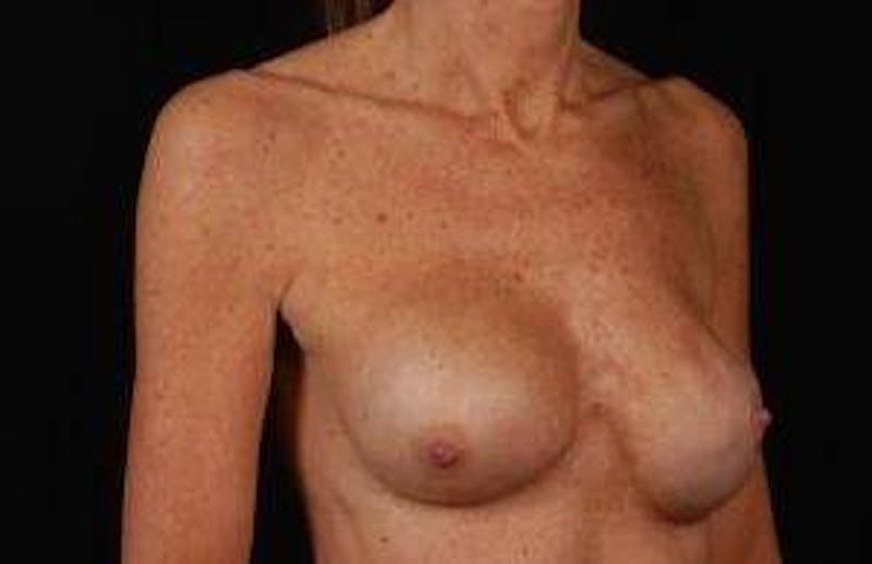Reconstructive Breast Revision Before & After Gallery - Patient 155176 - Image 9