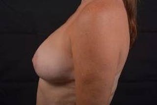 Oncoplastic Reconstruction Before & After Gallery - Patient 108736 - Image 4