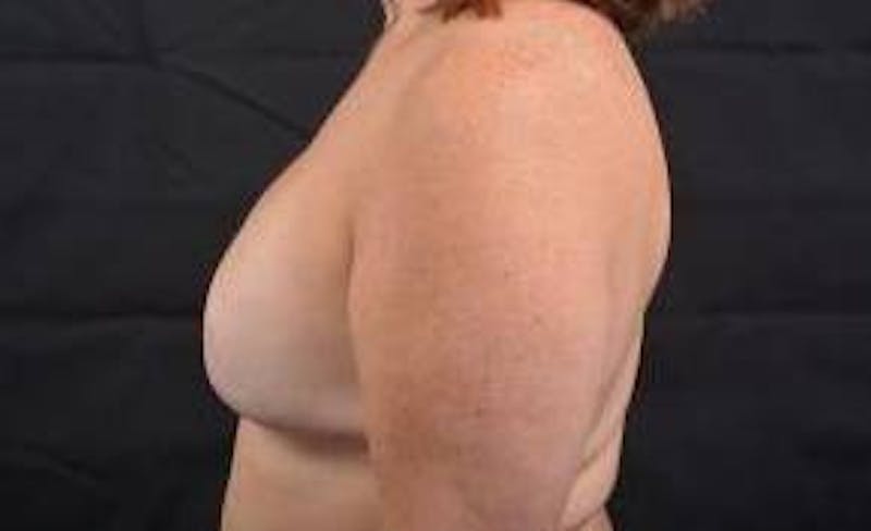 Reconstructive Breast Revision Before & After Gallery - Patient 723730 - Image 3