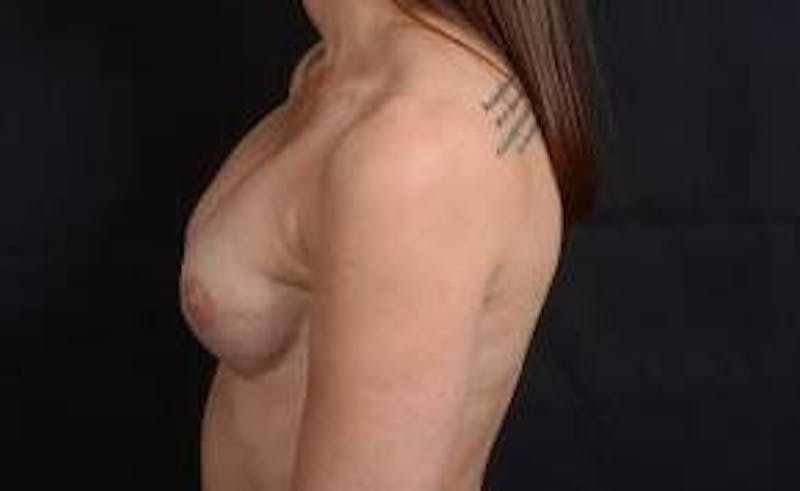 Immediate Breast Reconstruction – Nipple Sparing Before & After Gallery - Patient 938885 - Image 3