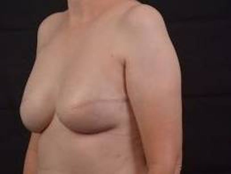 Immediate Breast Reconstruction – Skin Sparing Before & After Gallery - Patient 273114 - Image 8
