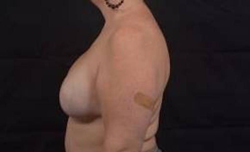 Reconstructive Breast Revision Before & After Gallery - Patient 723730 - Image 4