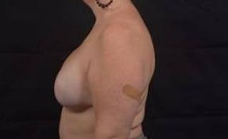 Reconstructive Breast Revision Before & After Gallery - Patient 723730 - Image 4