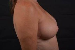 Oncoplastic Reconstruction Before & After Gallery - Patient 108736 - Image 6