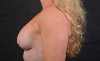 Aesthetic Breast Revision Before & After Gallery - Patient 393082 - Image 4