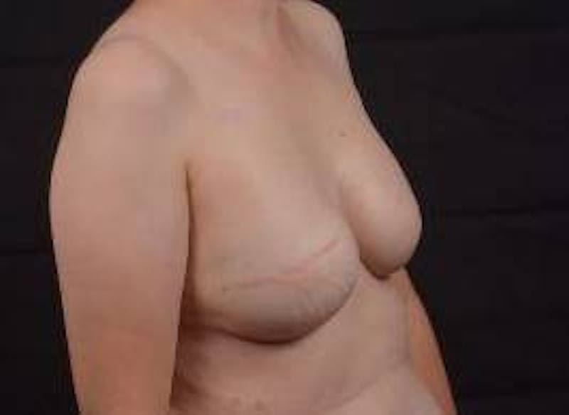 Immediate Breast Reconstruction – Skin Sparing Before & After Gallery - Patient 273114 - Image 10