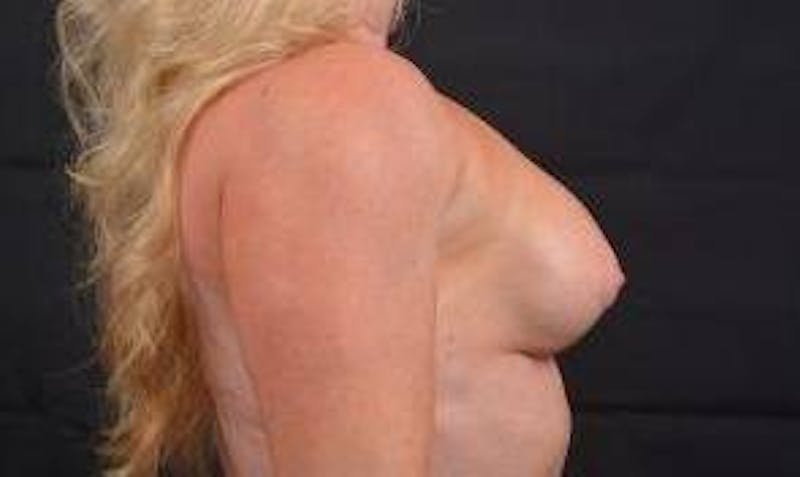 Aesthetic Breast Revision Before & After Gallery - Patient 393082 - Image 5