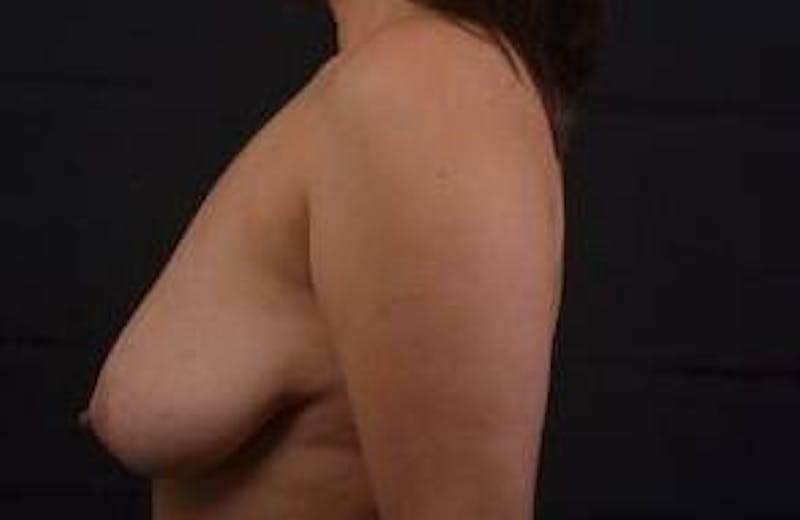 Mastopexy Before & After Gallery - Patient 155574 - Image 3