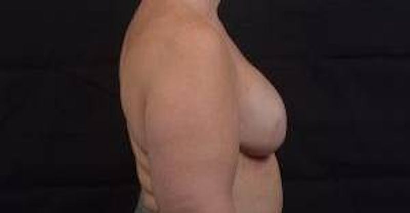 Reconstructive Breast Revision Before & After Gallery - Patient 723730 - Image 6