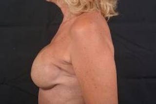 Immediate Breast Reconstruction – Skin Sparing Before & After Gallery - Patient 297506 - Image 4