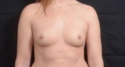 Breast Augmentation Silicone Gel Before & After Gallery - Patient 724263 - Image 1
