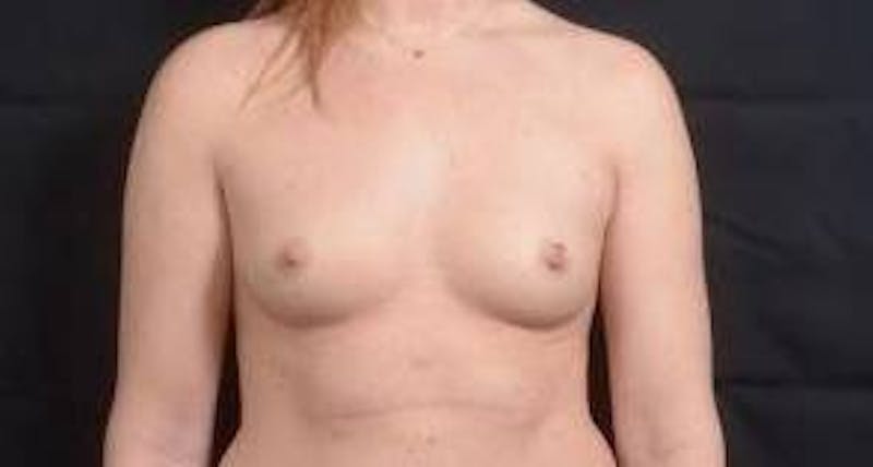 Breast Augmentation Silicone Gel Before & After Gallery - Patient 724263 - Image 1
