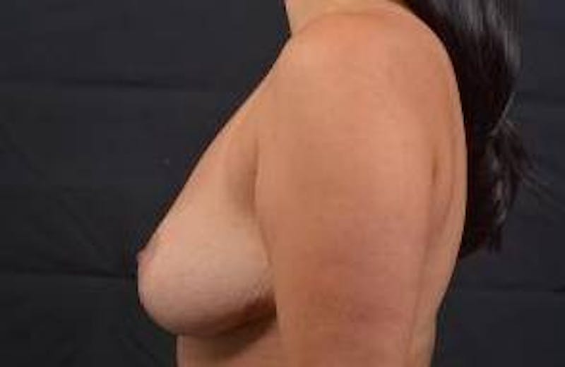 Mastopexy Before & After Gallery - Patient 155574 - Image 4