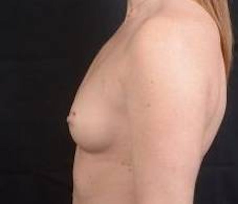 Breast Augmentation Silicone Gel Before & After Gallery - Patient 724263 - Image 3