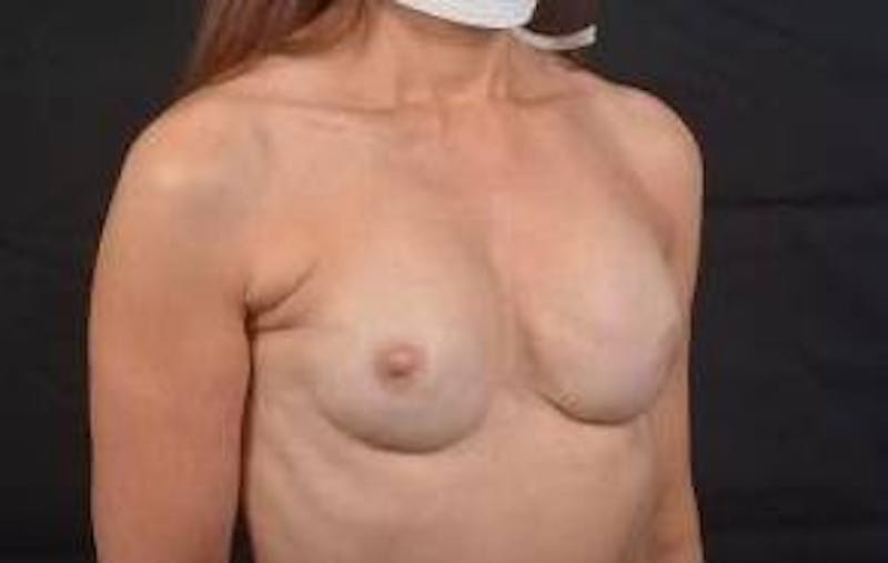 Immediate Breast Reconstruction – Nipple Sparing Before & After Gallery - Patient 938885 - Image 8