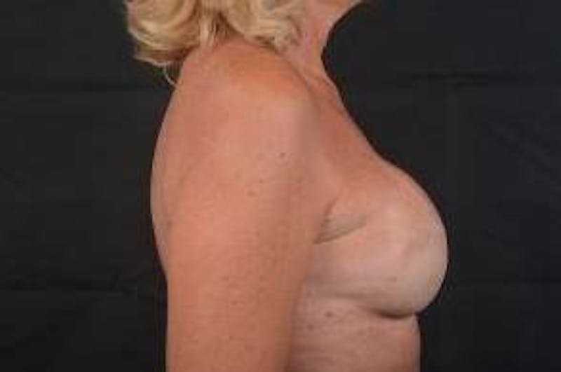 Immediate Breast Reconstruction – Skin Sparing Before & After Gallery - Patient 297506 - Image 6