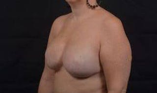Reconstructive Breast Revision Before & After Gallery - Patient 723730 - Image 8