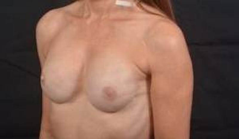 Immediate Breast Reconstruction – Nipple Sparing Before & After Gallery - Patient 938885 - Image 10