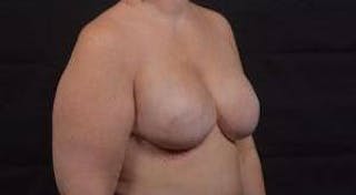 Reconstructive Breast Revision Before & After Gallery - Patient 723730 - Image 10
