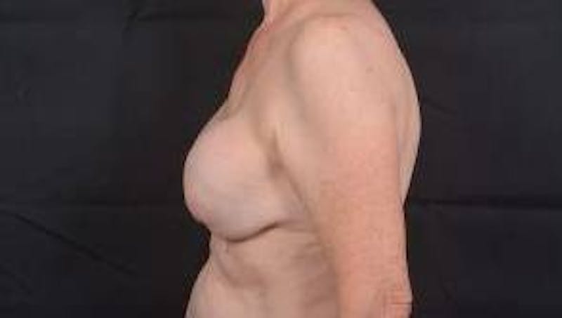 Breast Augmentation Mastopexy Before & After Gallery - Patient 563443 - Image 3