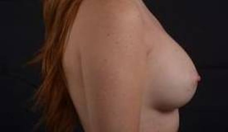 Breast Augmentation Silicone Gel Before & After Gallery - Patient 724263 - Image 6