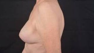 Breast Augmentation Mastopexy Before & After Gallery - Patient 563443 - Image 4