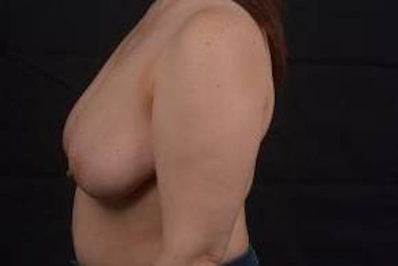 Immediate Breast Reconstruction – Skin Sparing Before & After Gallery - Patient 358522 - Image 3