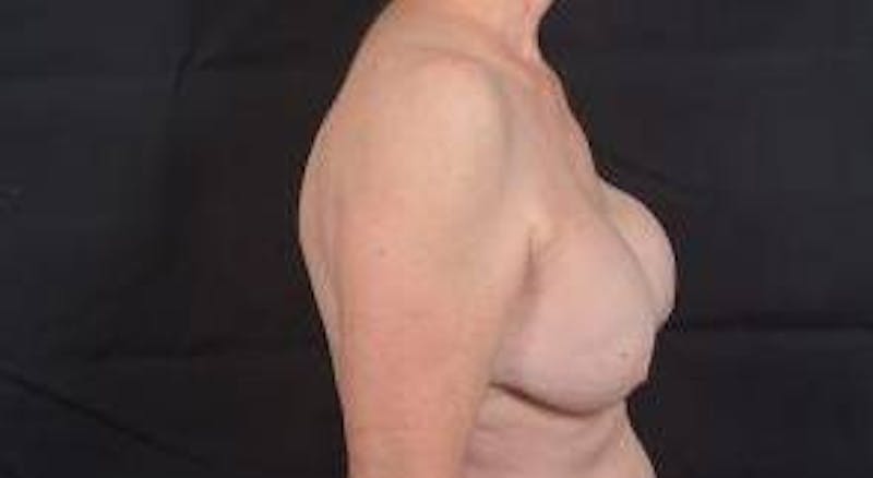 Breast Augmentation Mastopexy Before & After Gallery - Patient 563443 - Image 5